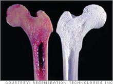 Regeneration Technologies displays a bone graft that has been BioCleansed (right) versus one that has not (left.)