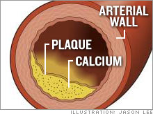Plaque causes heart disease but it is hard to measure. Calcium, a marker for plaque, shows up on body scans. A high calcium score means an increased risk of heart disease.