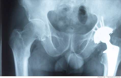 Joint Replacement Surgery: What You Need To Know - Aug. 5, 2011